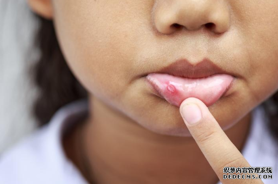 杏耀平台 8种消除口腔溃