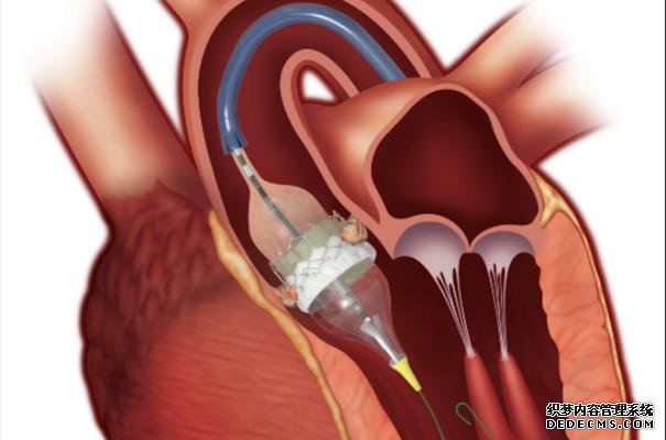 TAVR是主动脉瓣置换术杏耀网站的主要形式，在美国效果稳步改善