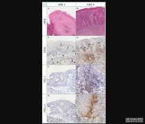<b>癌靶:PD-1/PD-L1在肛门杏耀游戏鳞状上皮内病变中的</b>