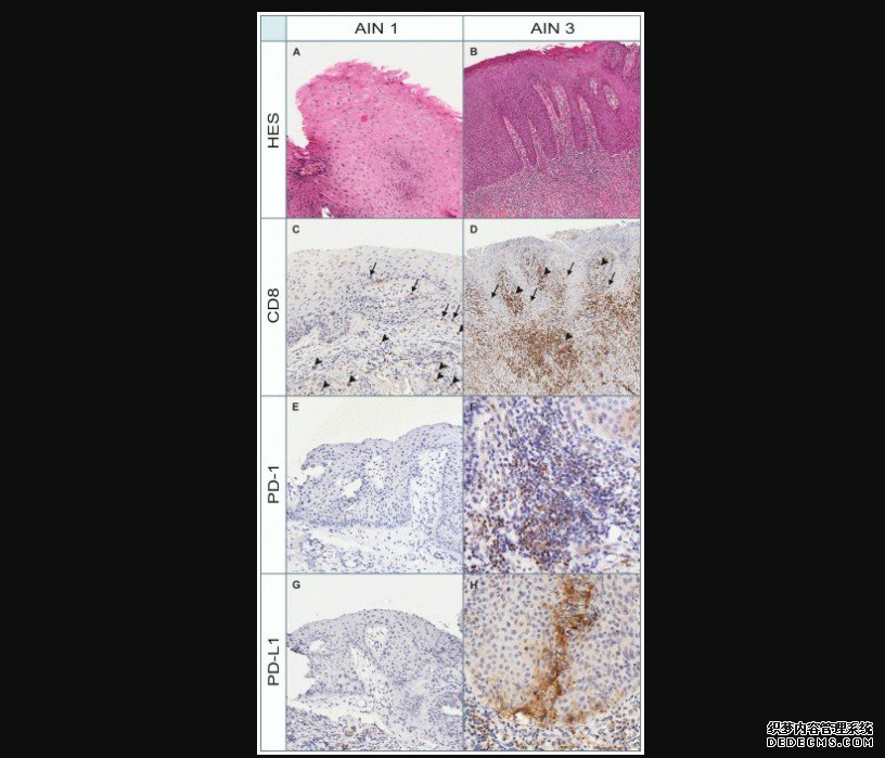 癌靶:PD-1/PD-L1在肛门杏耀游戏鳞状上皮内病变中的表达